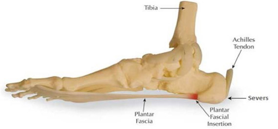 Heel Pain - Foot Bio Tec